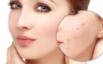 Altın İğne ile Akne Tedavisi