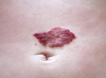 Doğum Lekesi Tedavisi