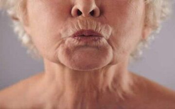 Dudak Çevresi Kırışıklığı