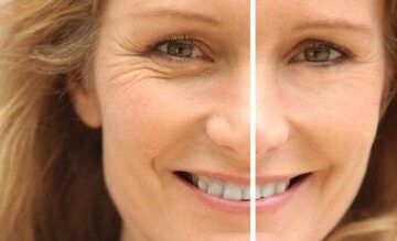 Göz Çevresi Kırışıklığı