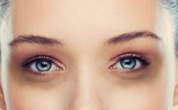 Gözaltı Morluk Tedavisi