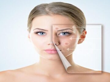 İğneli Radyofrekans ile Sivilce ve İz Tedavisi