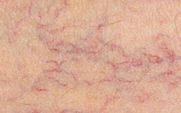 Kılcal Damar Tedavisi