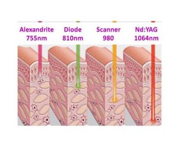 Lazer Epilasyonda Kullanılan Cihazlar