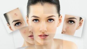 Lazer ile Cilt Tedavileri