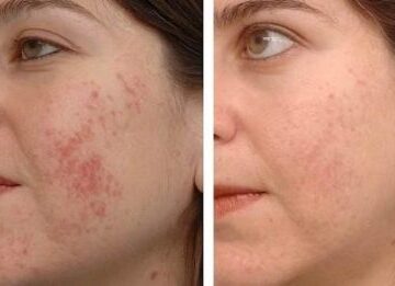 Sivilce İzi Nasıl Tedavi Edilir?