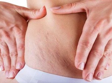 Theramegnetic ile Çatlak Tedavisi