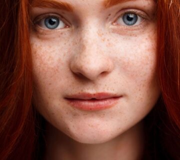 Ankara cil ve leke tedavisi scaled 1 360x320