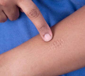 Ankara yara izi tedavisi scaled 1 360x320