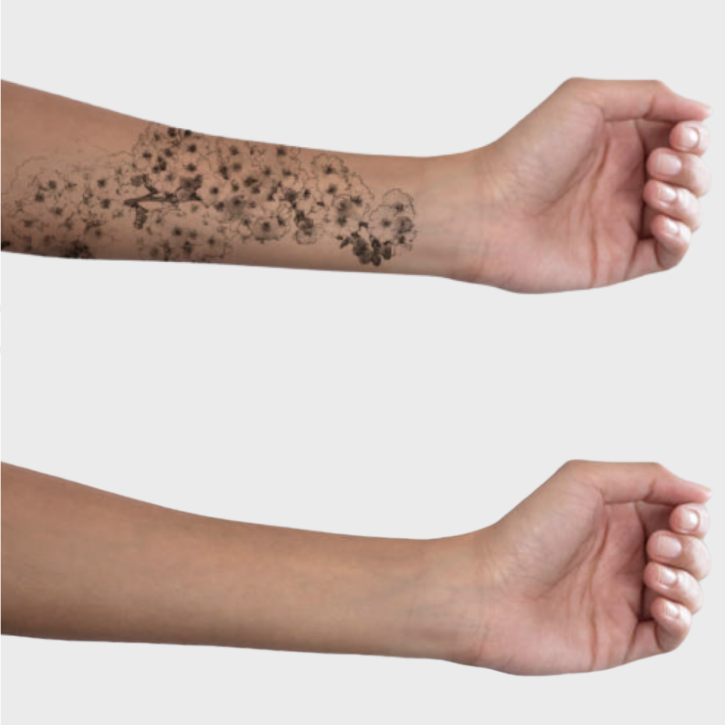 Dermabrazyon ile dovme sildirme