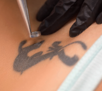 Laser ile dovme sildirme