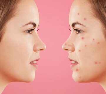 ankara-sivilce-tedavisi