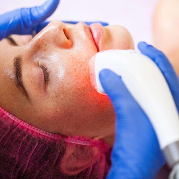 Dermabrazyon Nedir 600x600