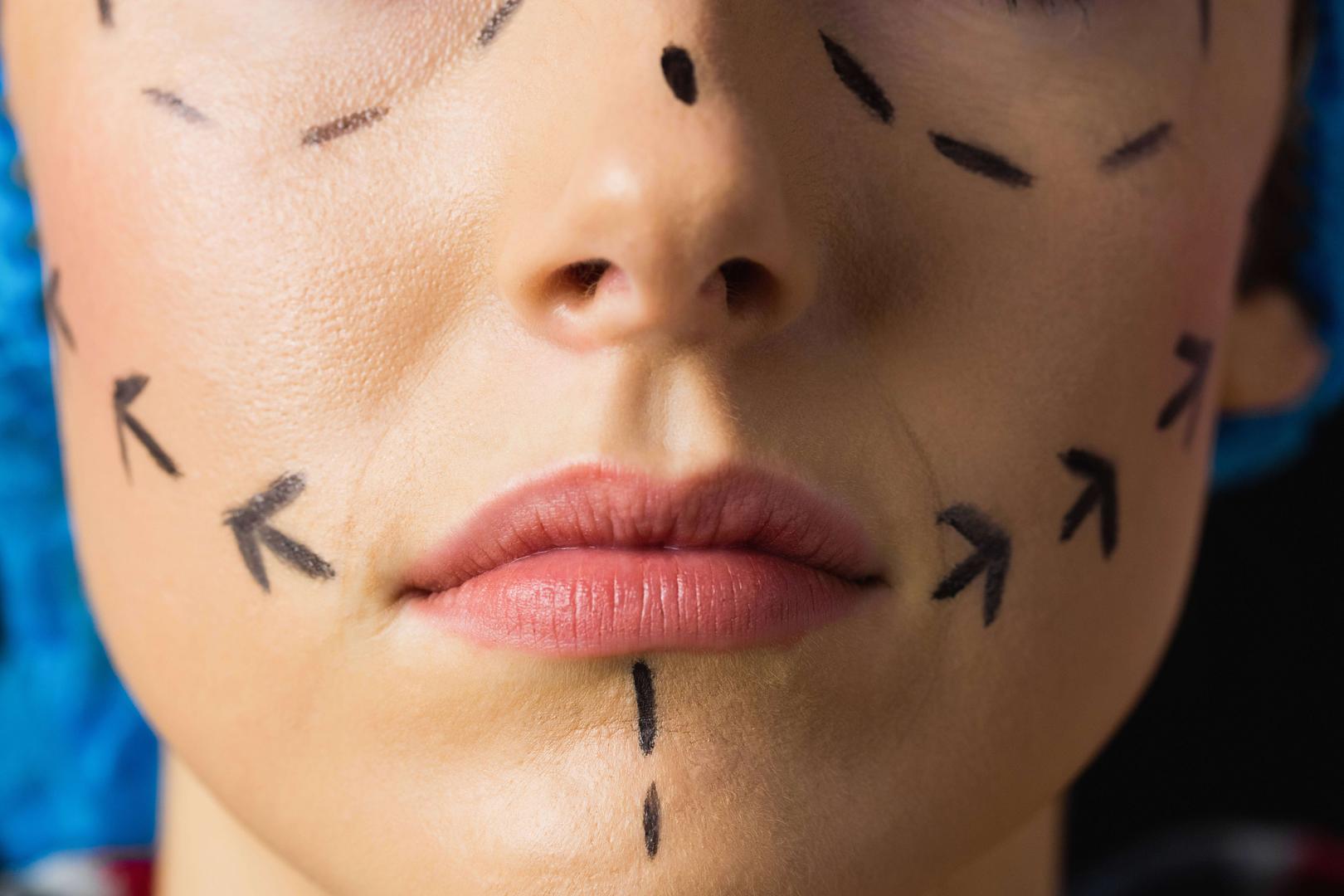 Ankara cilt dolgusu tedavisi