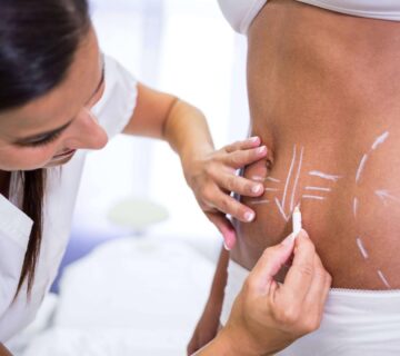 Ankara velashape tedavisi 360x320