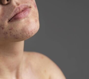 Cilt hastaliklari 360x320