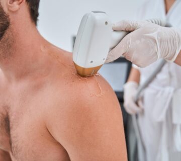 Omuz lazer epilasyon 360x320