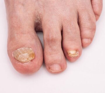 Tirnak mantari tedavisi 360x320