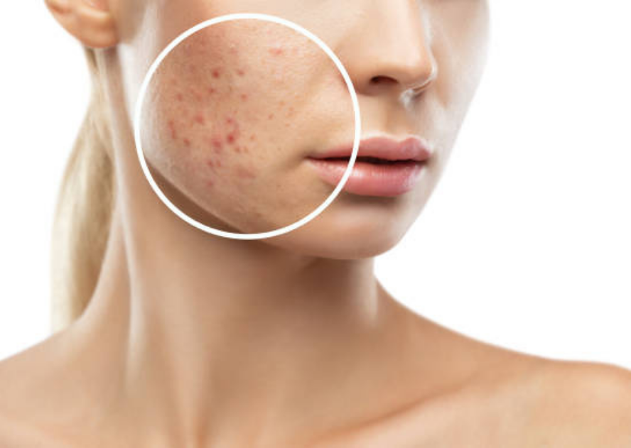 Akneli ve akneye meyilli ciltlere ozel cilt bakimi