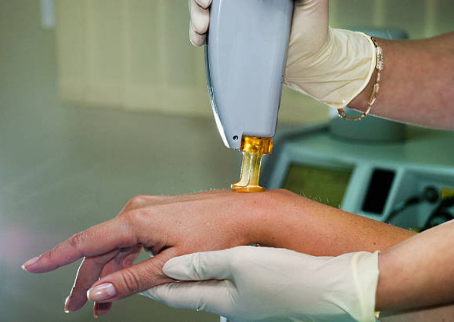 Lazer epilasyon yanigi nedir nasil gecer