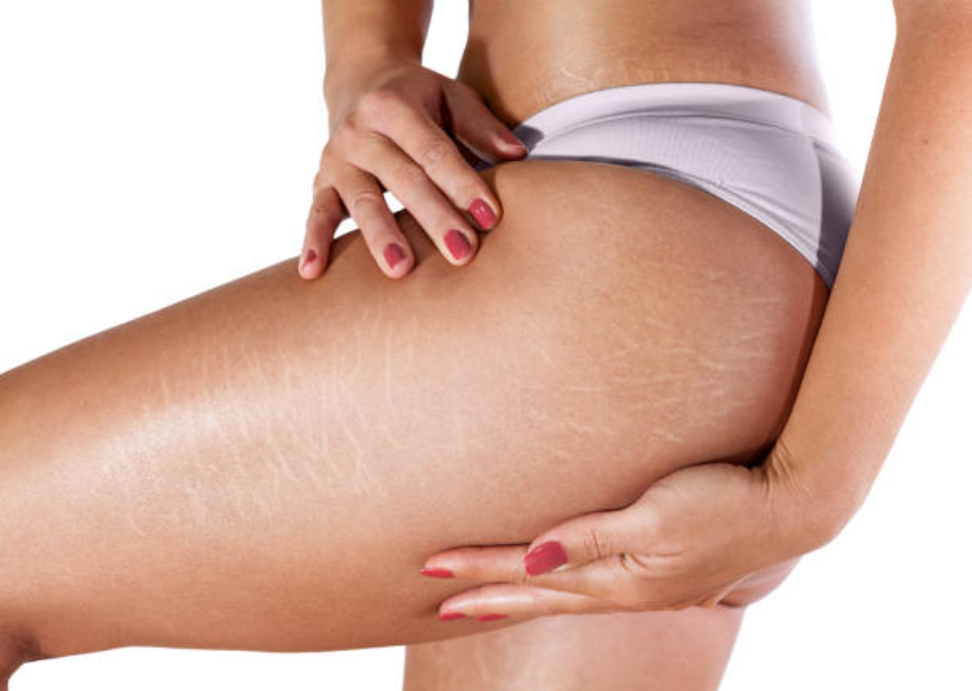 Vucut catlaklarindan nasil kurtulabilirim