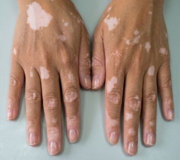 Vitiligo nedir 360x320