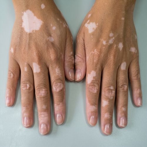 Vitiligo nedir